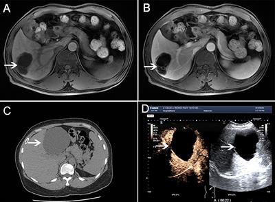 Intrahepatic biliary cystadenoma: Confusion, experience, and lessons learned from our center